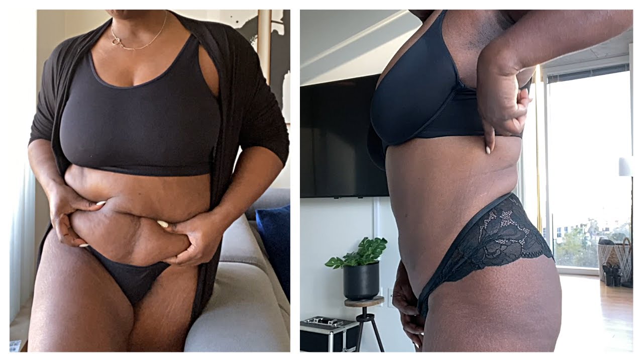 Unveiling the Sono Bello Cost 2023: What to Expect for Your Body Contouring Journey