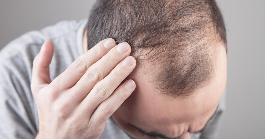All about hair loss – Symptoms, Causes and the treatment options
