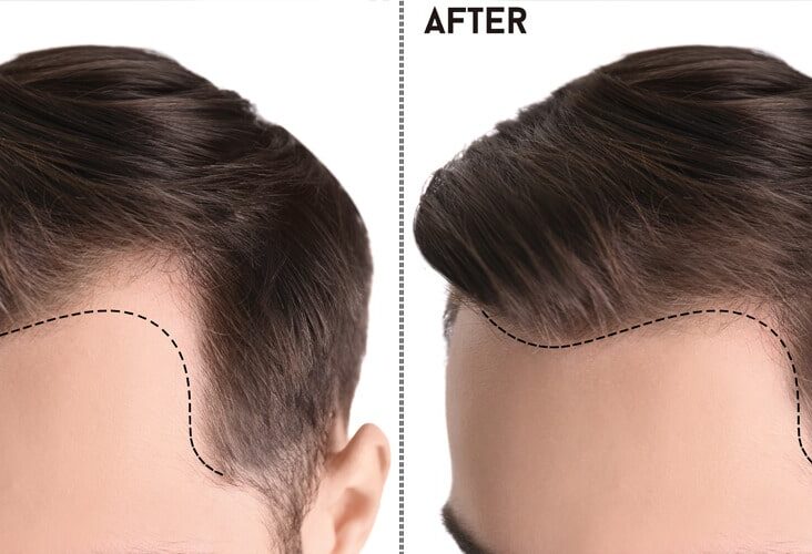 Best Hair Transplant in Pakistan