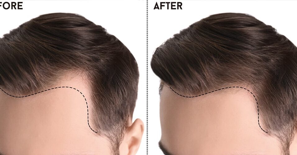 Best Hair Transplant in Pakistan