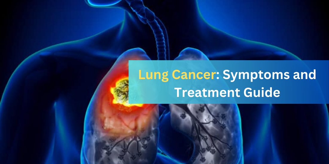 Lung Cancer Symptoms and Treatment Guide