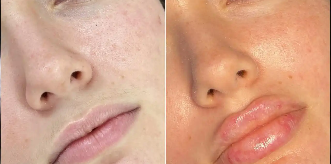 Juvederm Fillers