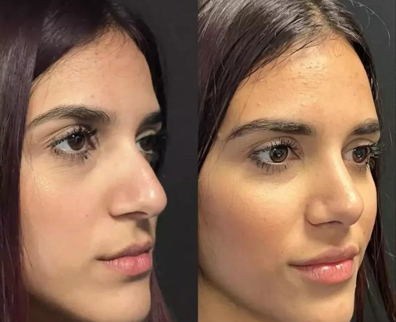 Rhinoplasty in Dubai: What to Expect and Prepare For