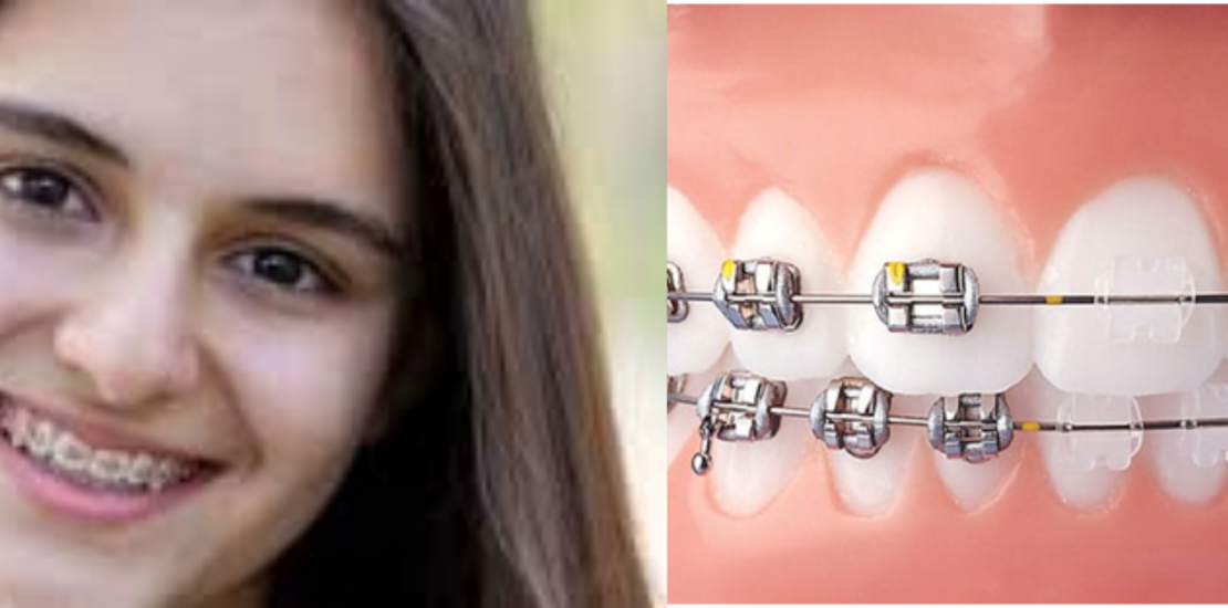 dental implants in jaipur