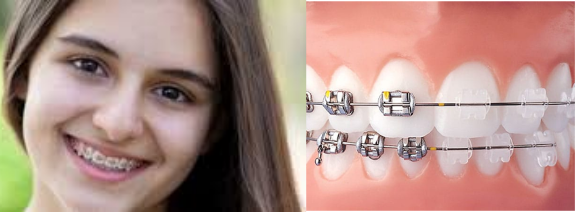 dental implants in jaipur