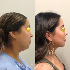 eyelid surgery cost