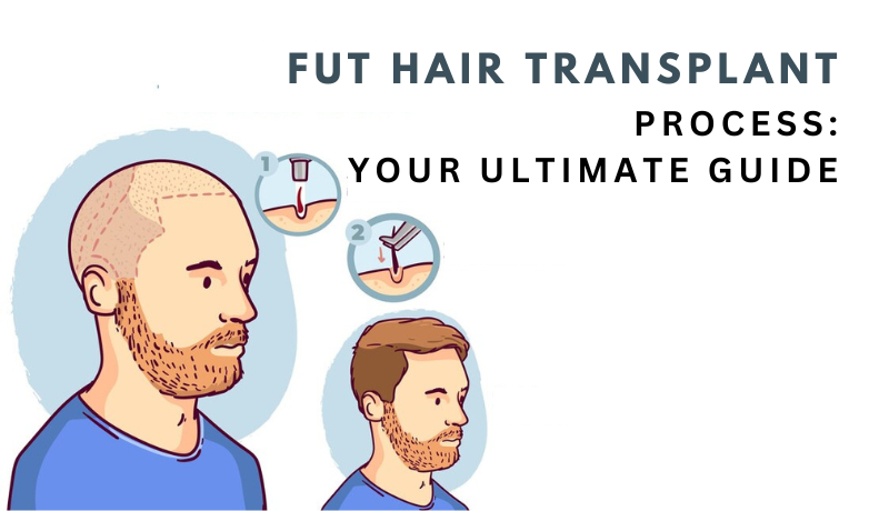 fut hair transplantation