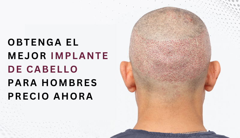 implante de cabello para hombres precio