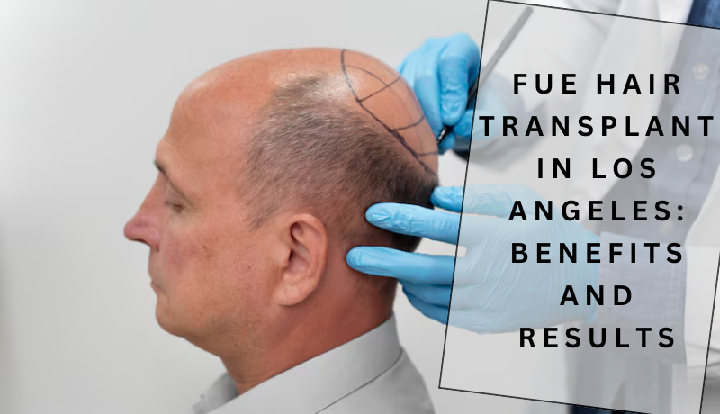 fue hair transplant in Los Angeles