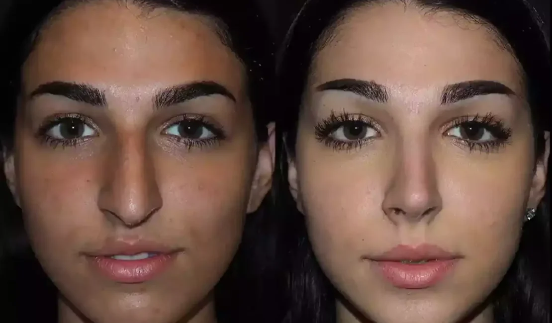 Nose Deviated Septum Surgery in Dubai: Restore Function and Comfort