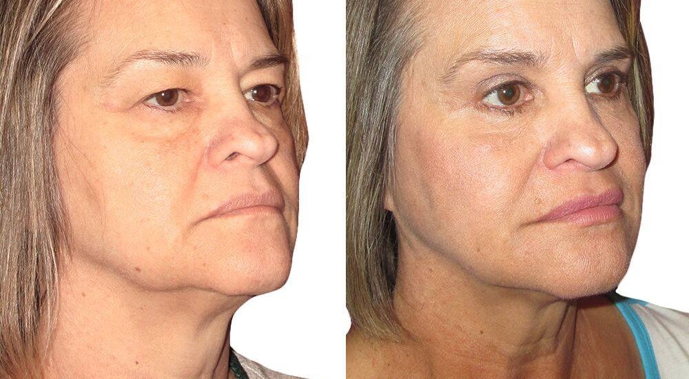 neck liposuction cost