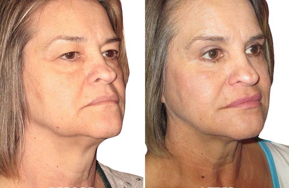 neck liposuction cost