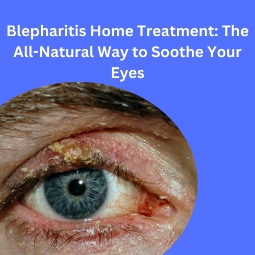 Blepharitis Home Treatment