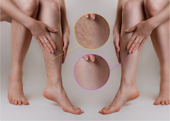 what does a vein clinic do