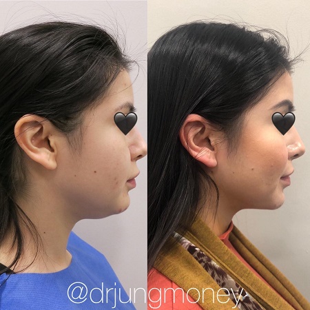 eye lift surgery