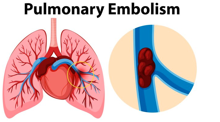 Pulmonary Embolism Treatment