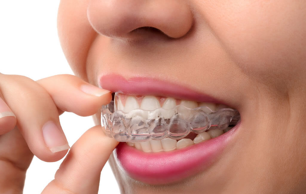 Bruxism Treatment