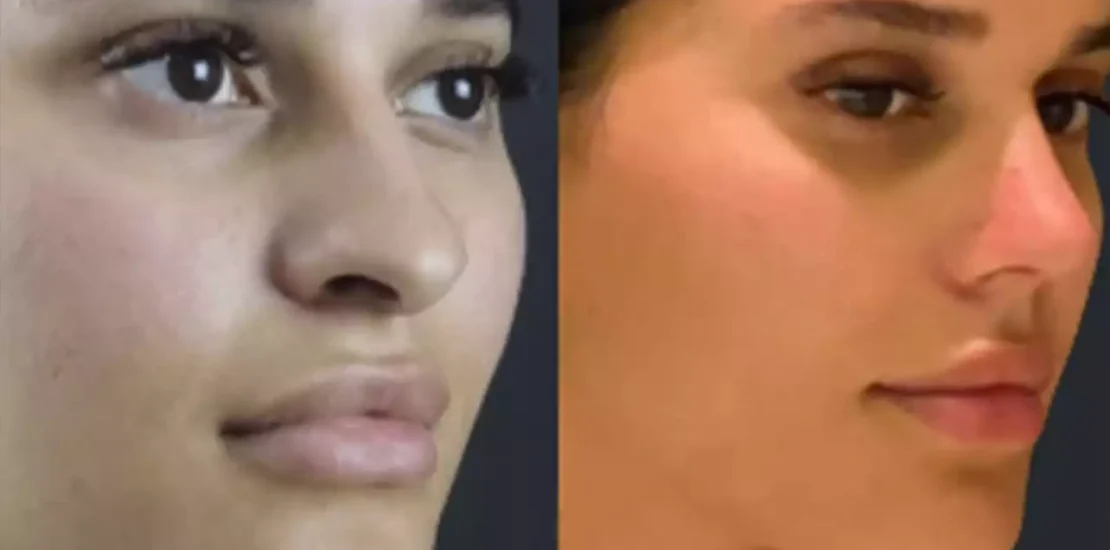 Advanced Techniques Used by the Best Doctors in Dubai for Septoplasty