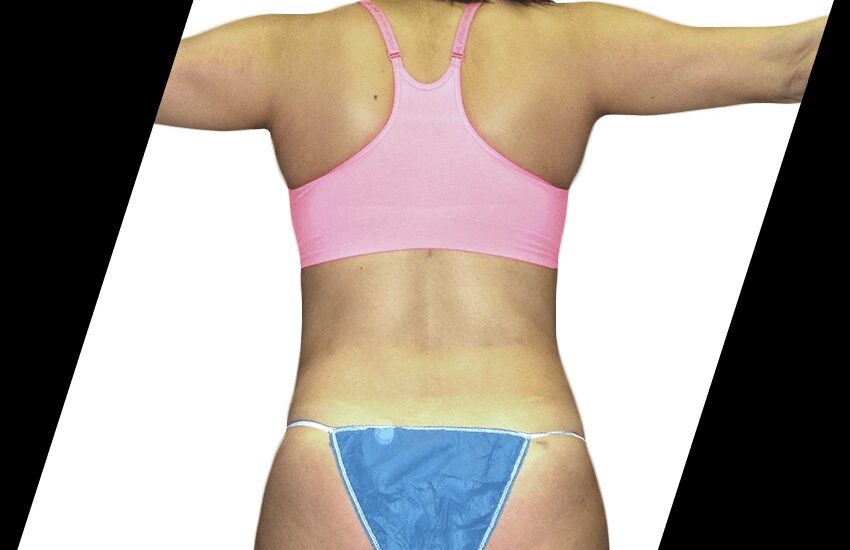 Arm Liposuction