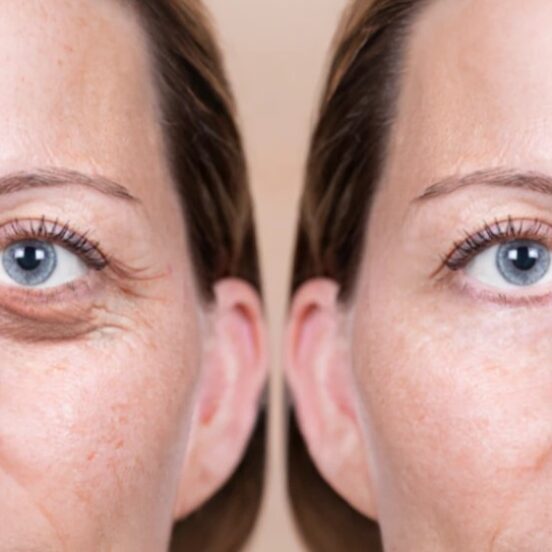 Eyelid Surgery