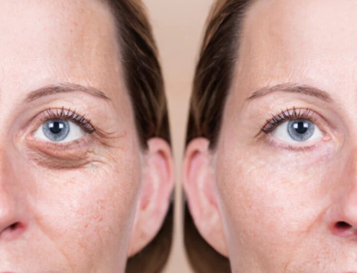 Eyelid Surgery