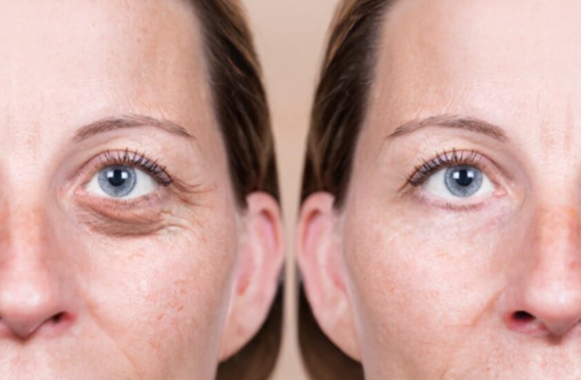 Eyelid Surgery