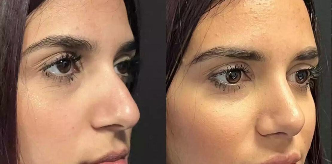 septoplasty in dubai