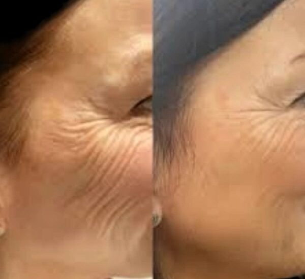 Profhilo injections in dubai