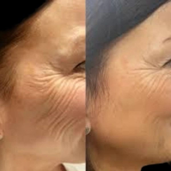 Profhilo injections in dubai