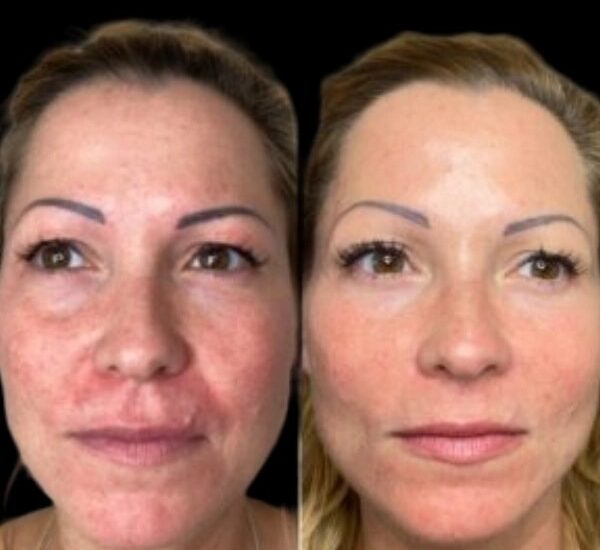 Profhilo treatments in dubai