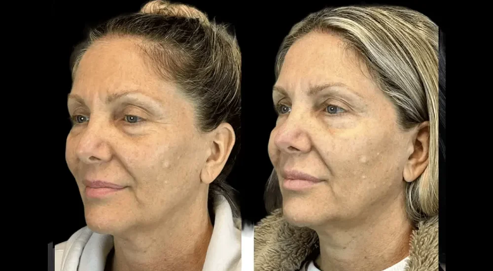 Botox in dubai