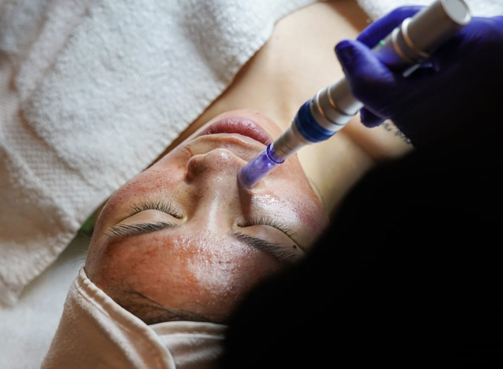Microneedling Arlington Va