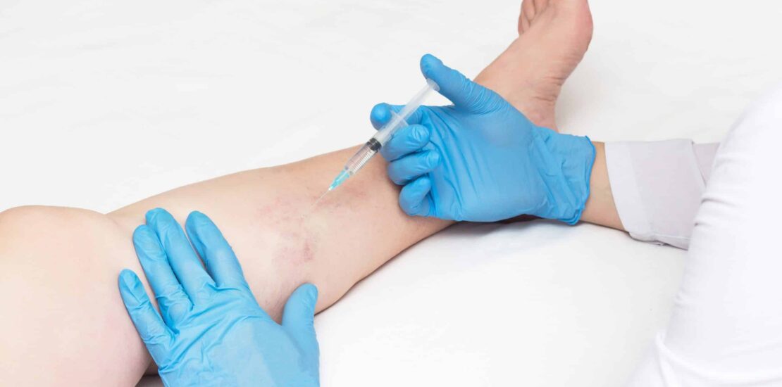 What doctor treats varicose veins