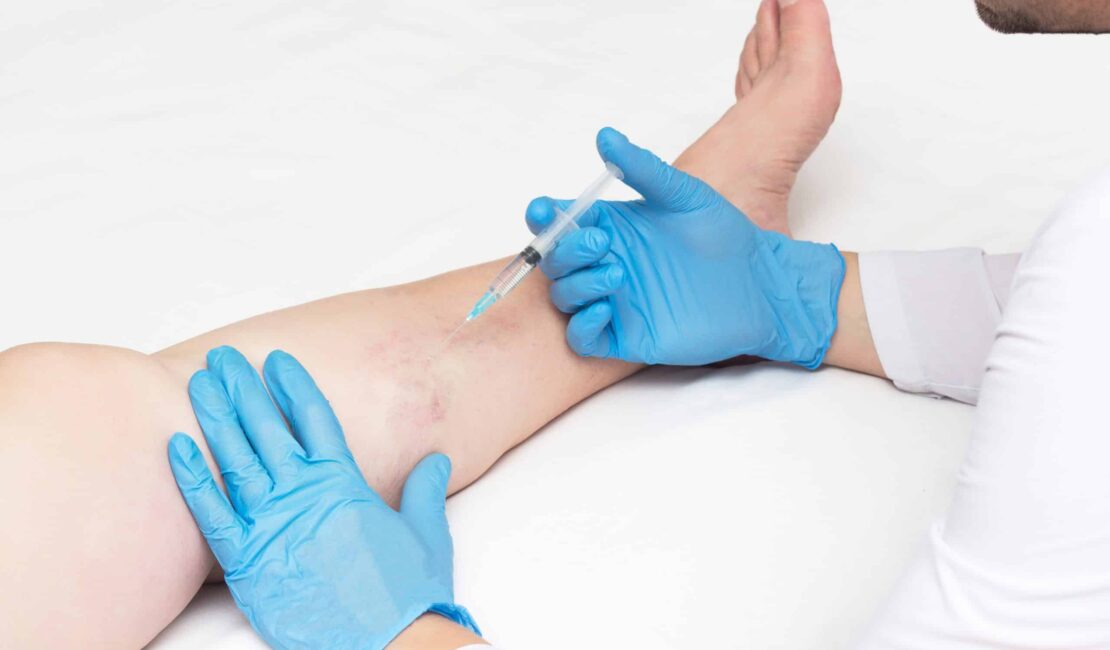 What doctor treats varicose veins
