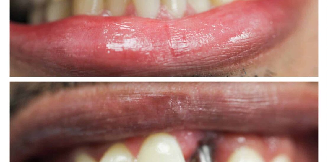 affordable implants and dentures near me