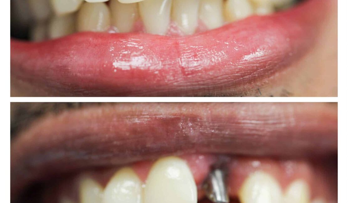 affordable implants and dentures near me