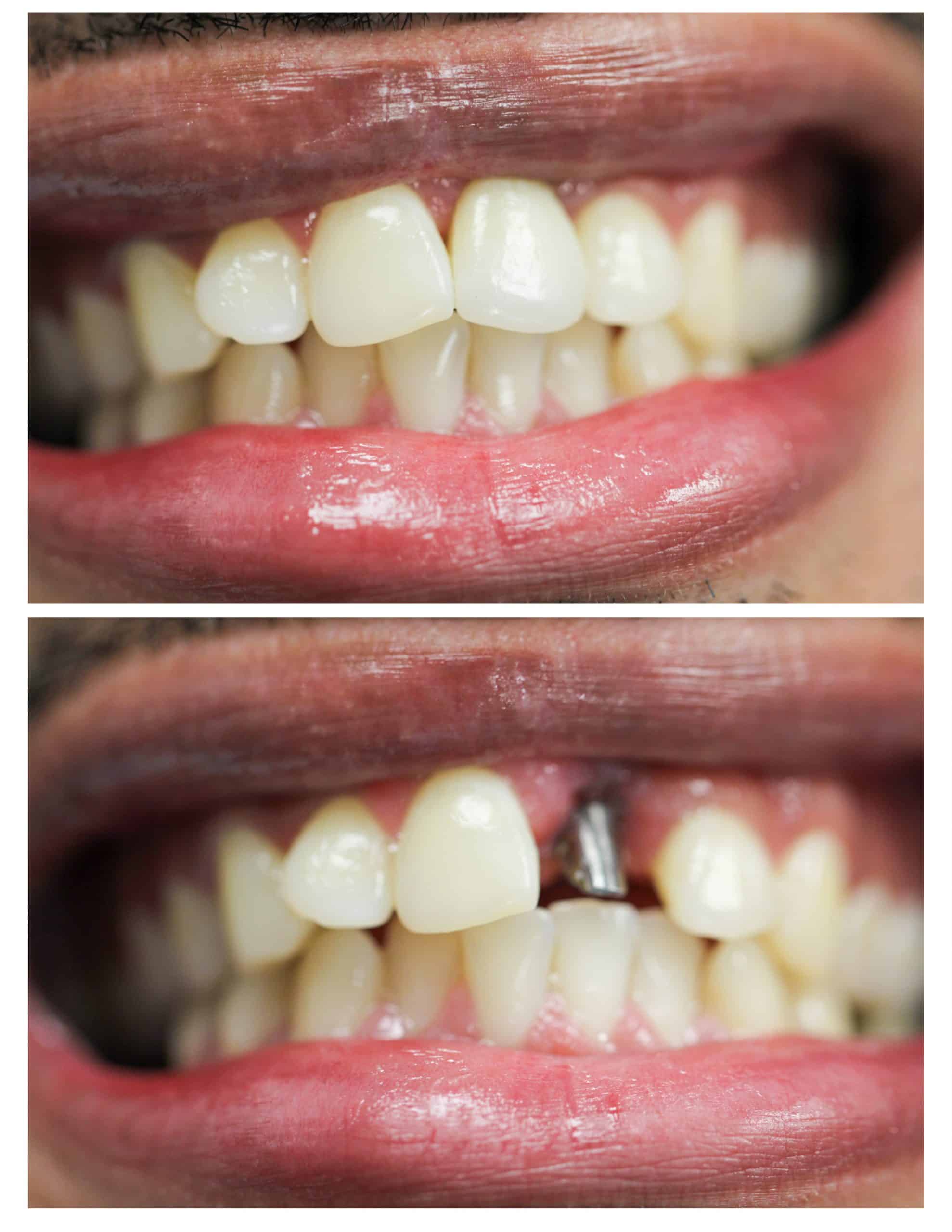 affordable implants and dentures near me