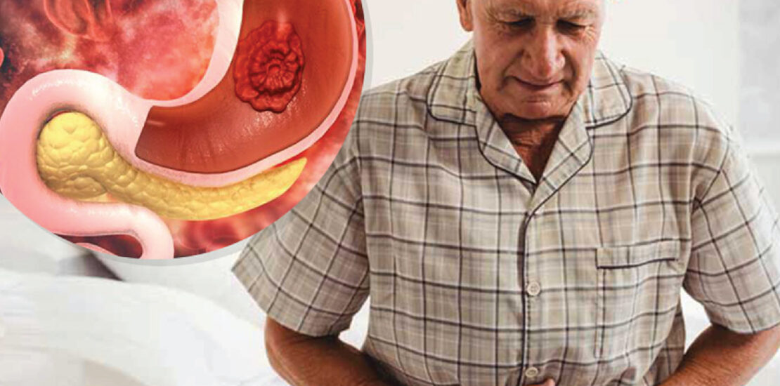 gastric cancer treatment in delhi