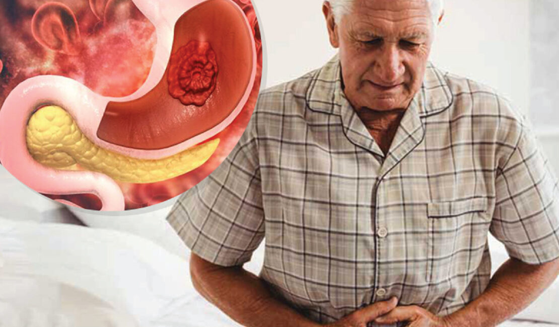 gastric cancer treatment in delhi