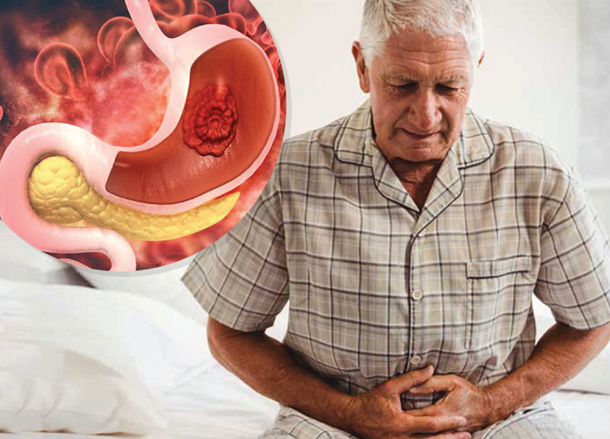 gastric cancer treatment in delhi