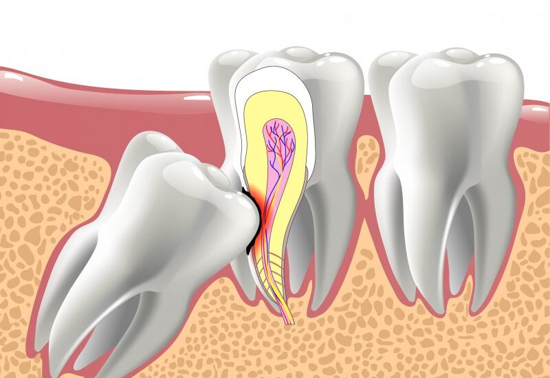 wisdom teeth extraction