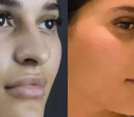 septoplasty in dubai