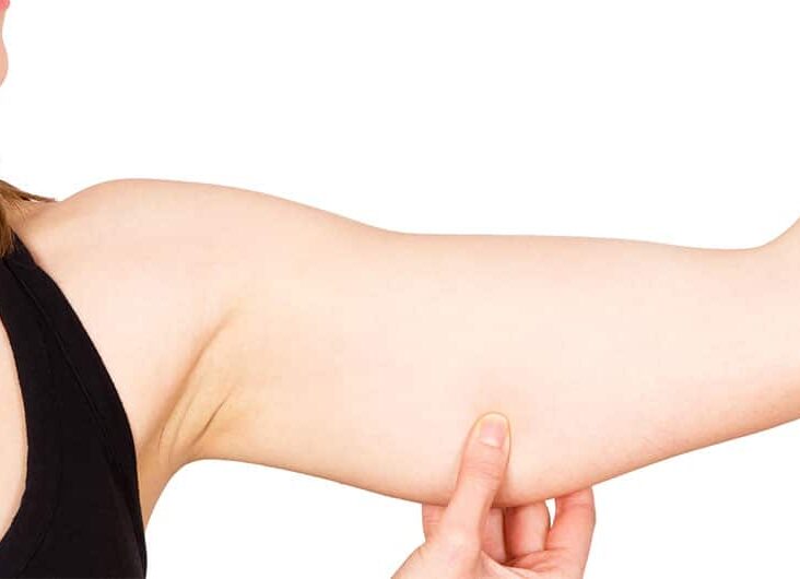 Arm Liposuction