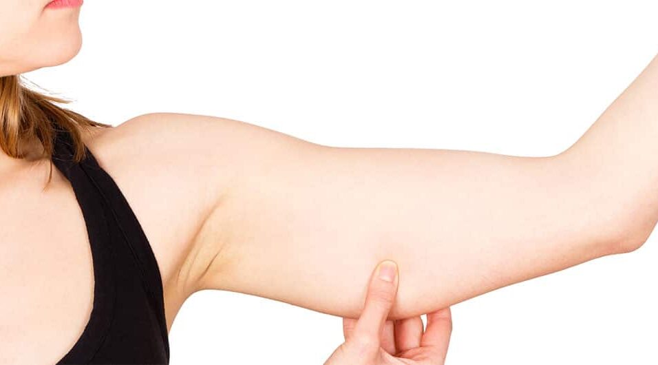 Arm Liposuction