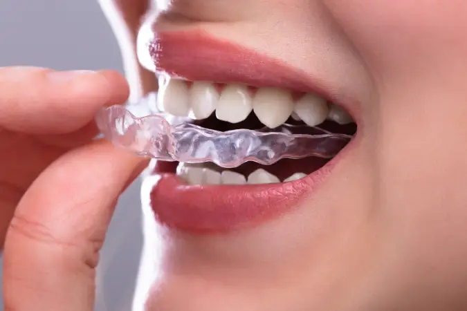 Dental bridges Houston