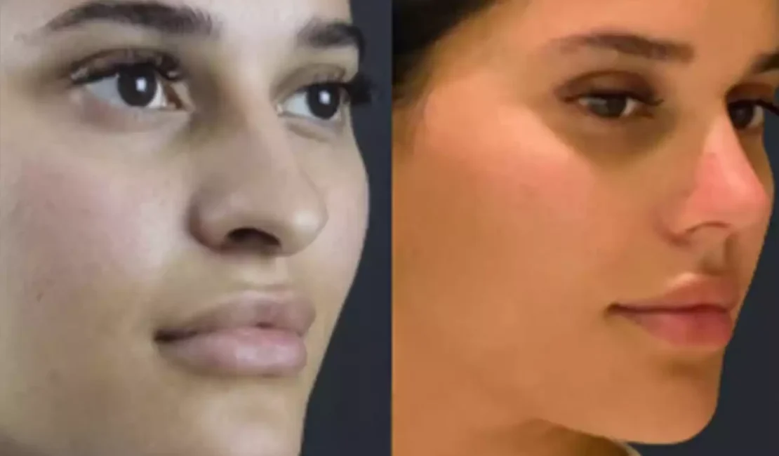 best rhinoplasty surgeon in dubai