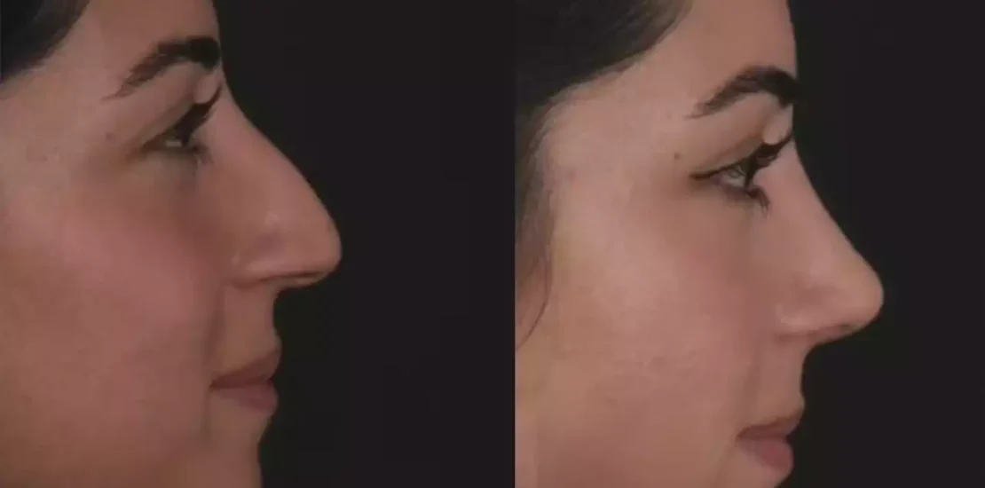 septoplasty in dubai