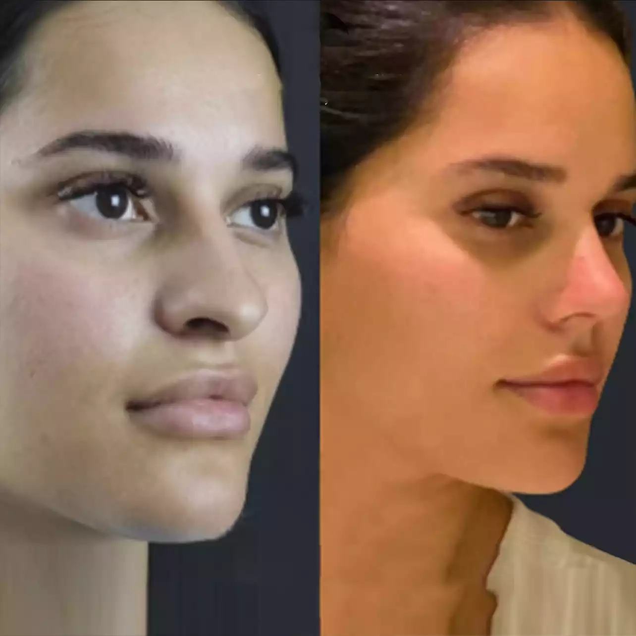 best rhinoplasty surgeon in dubai