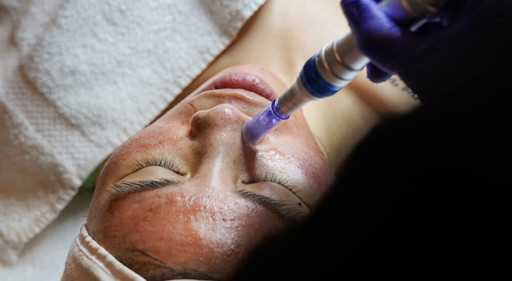 Microneedling Arlington Va