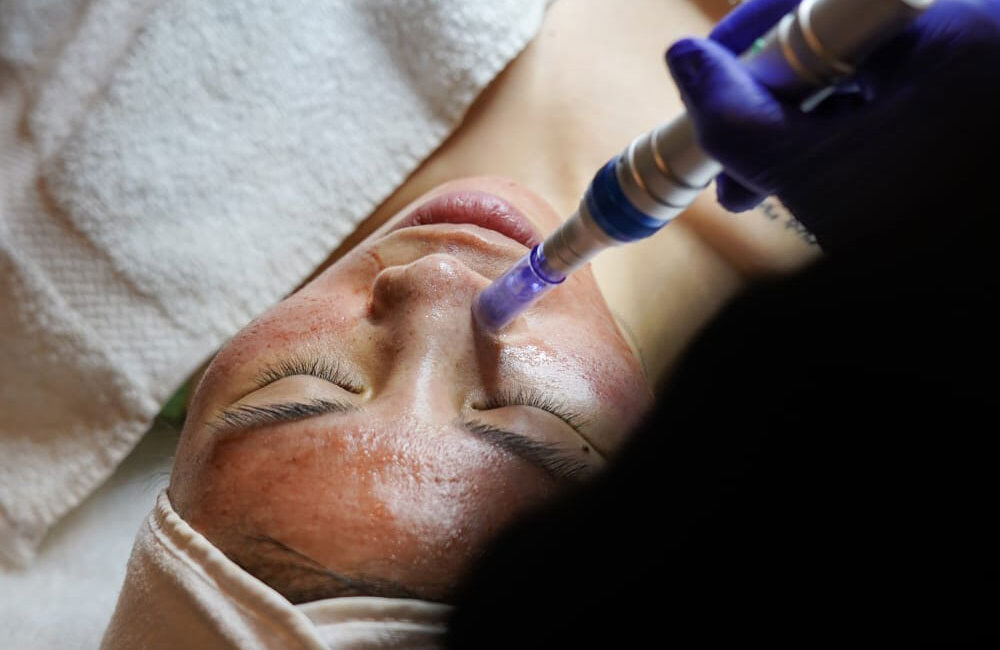 Microneedling Arlington Va